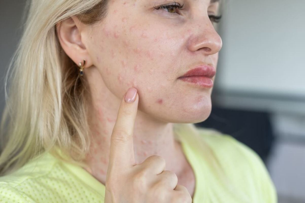 Skin Flare-Ups & Breakouts