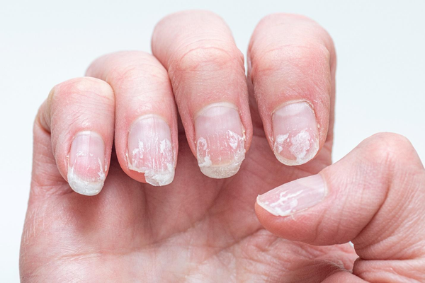 Hair Shedding & Brittle Nails